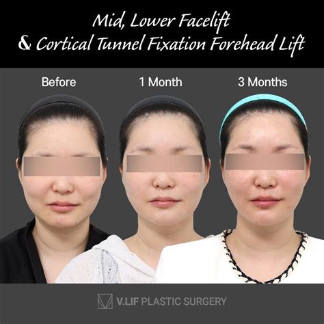 5 V.LIF Plastic Surgery .